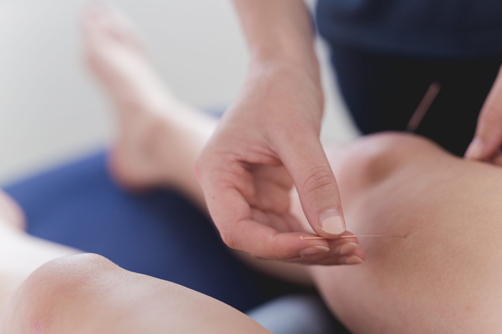 A physiotherapist placing an acupuncture needle near a patient’s knee